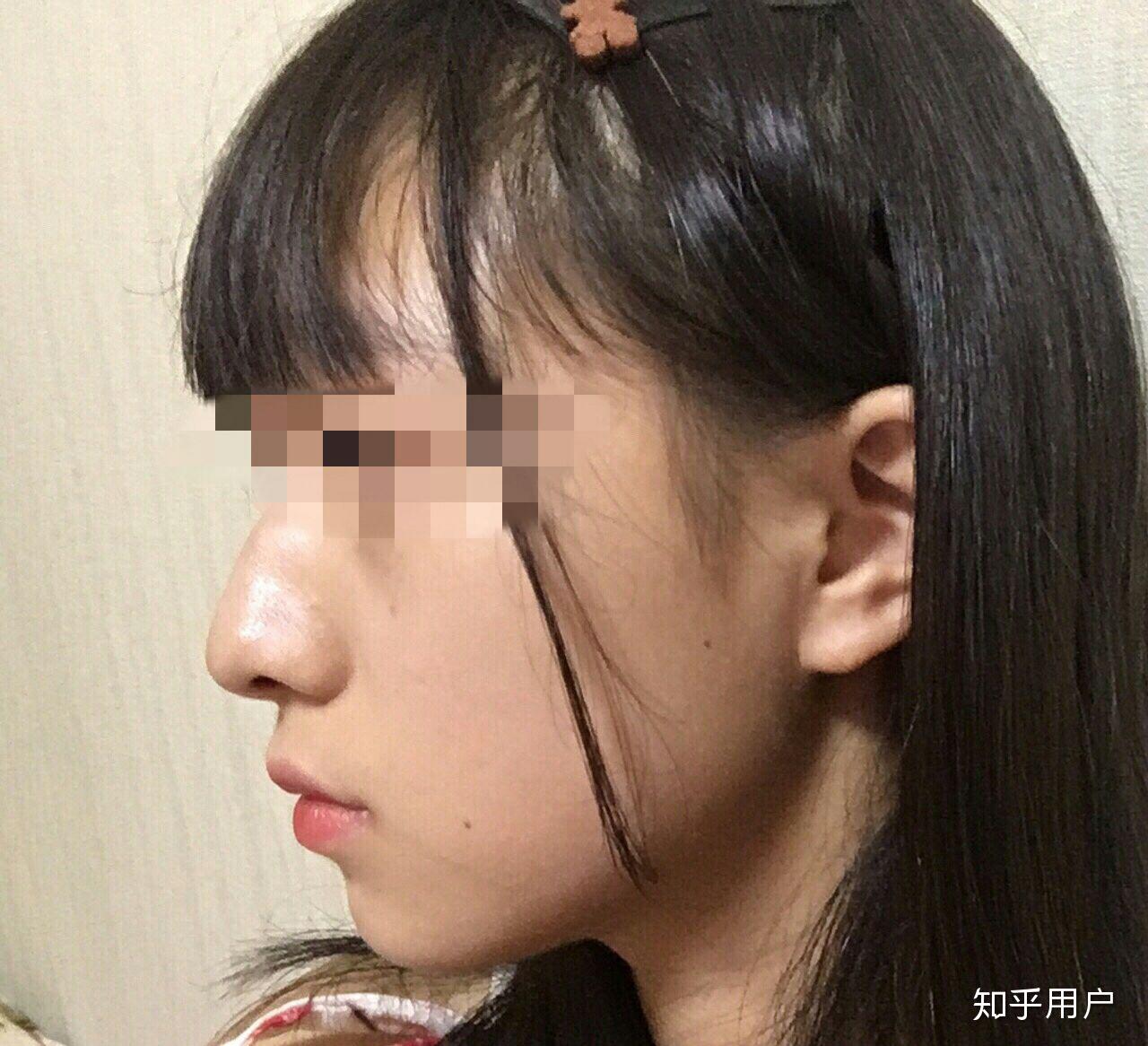 下巴后缩怎么办如图