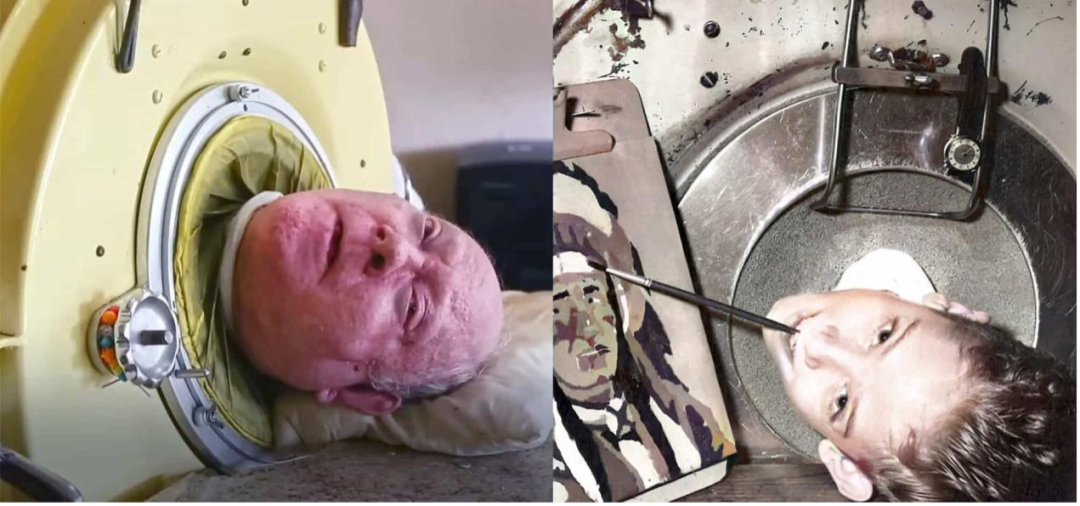 美国 77 岁男子靠铁肺生活 70 年,如何从医学角度解读该情况?