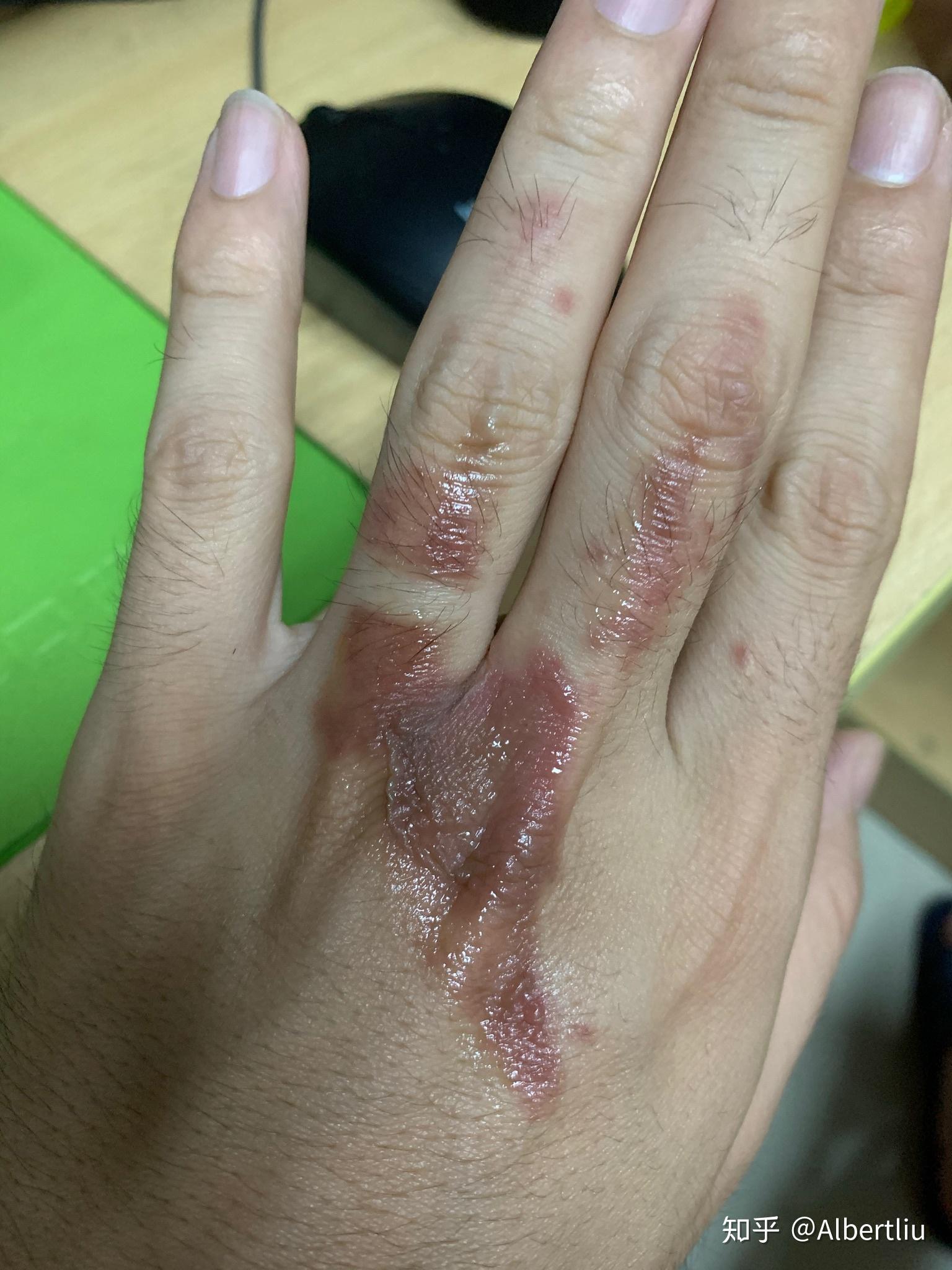 被油烫伤了起泡应该怎么办