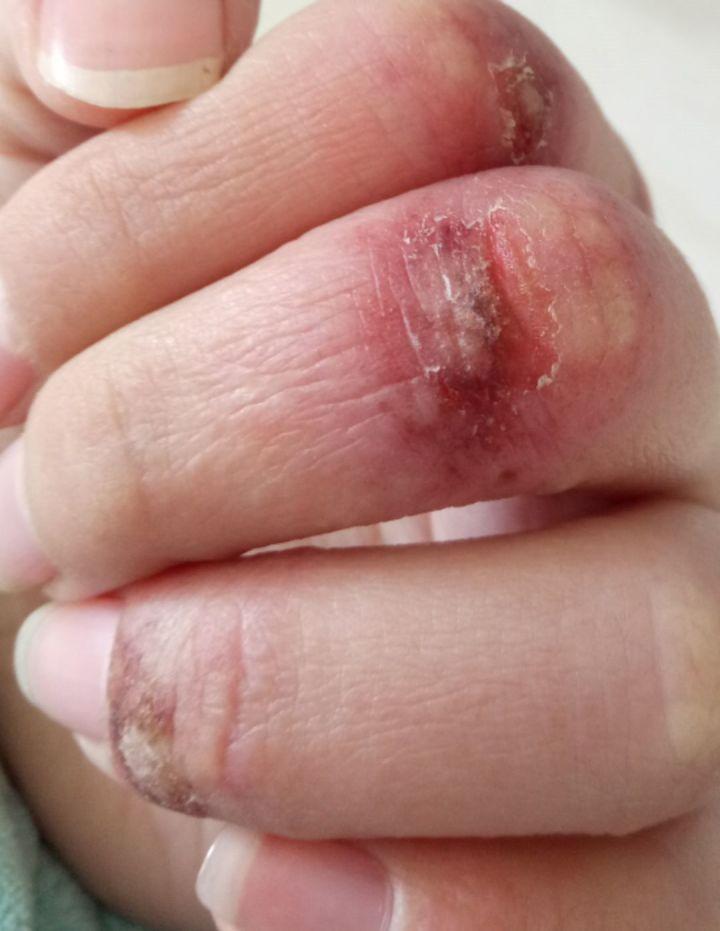 冬天防冻手技巧 寒冬来临,有的朋友每到这时候就容易长冻疮,手上或脚