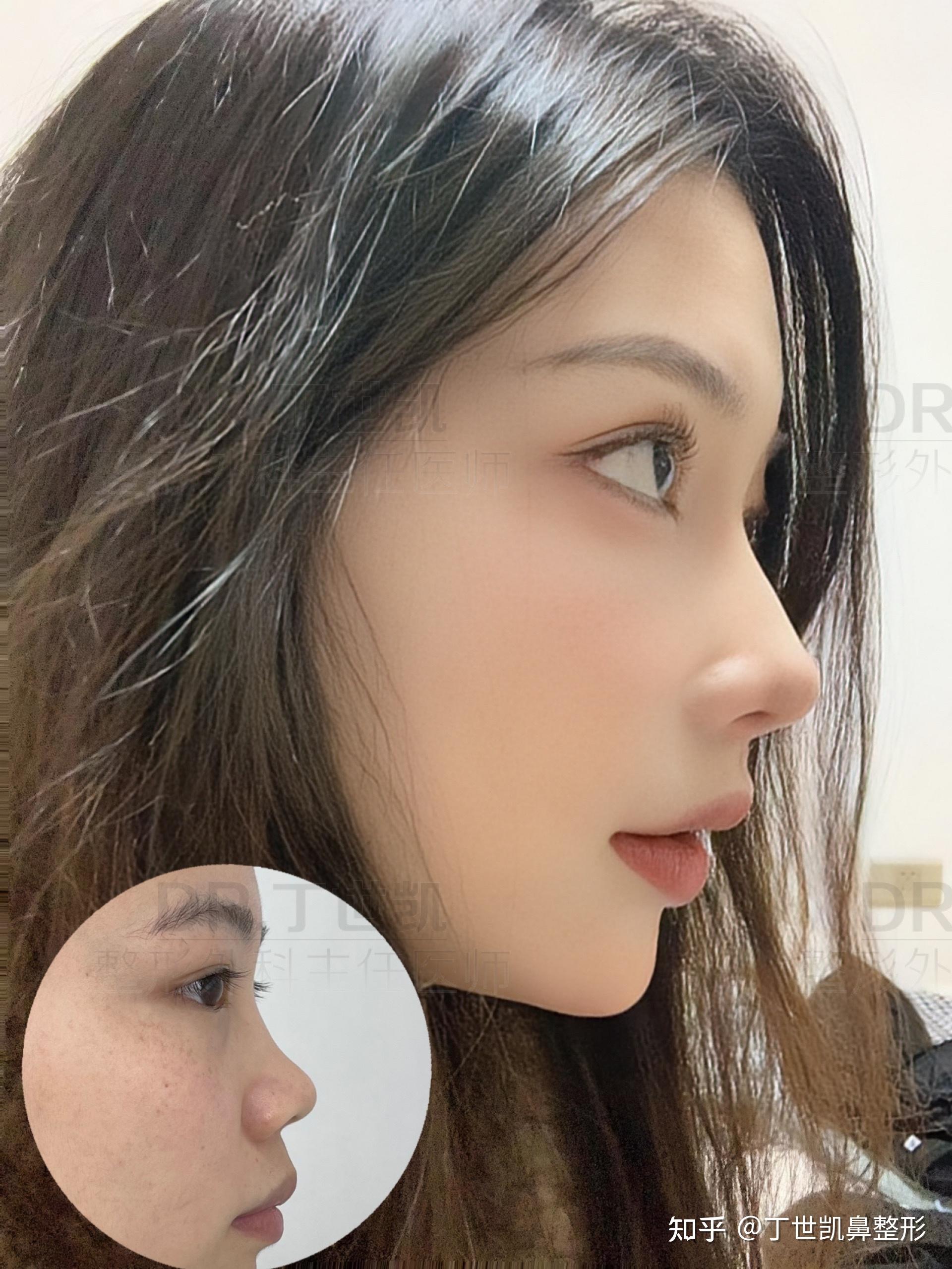 鼻整形可以按照模板做吗? - 知乎