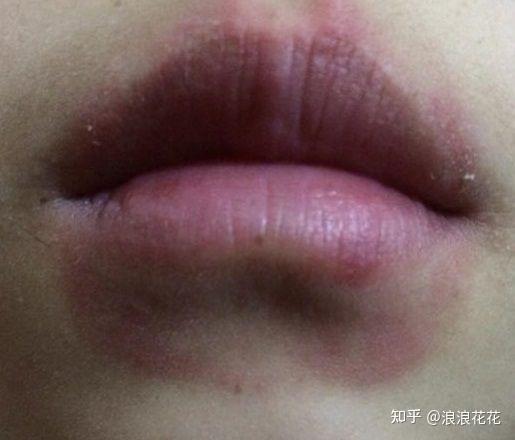 嘴唇周围一圈红印? - 知乎