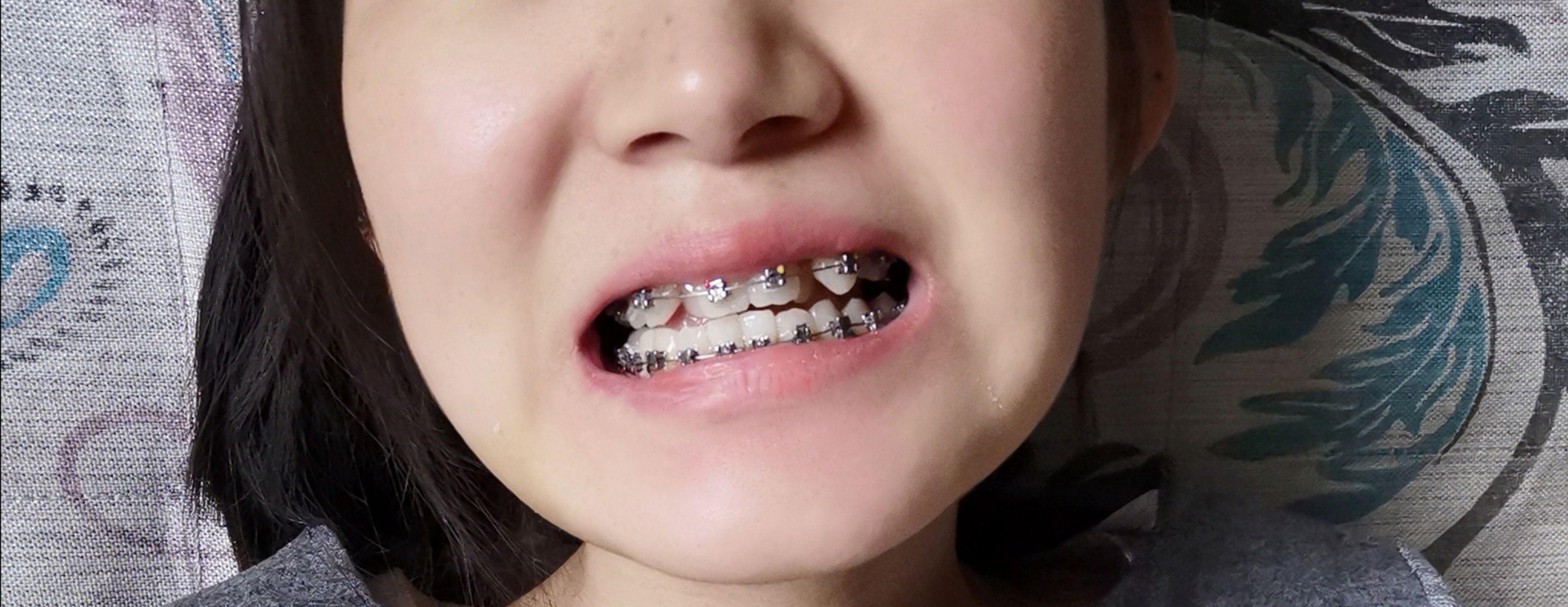 一个人同时长有虎牙和兔牙是什么样的感受? - 知乎