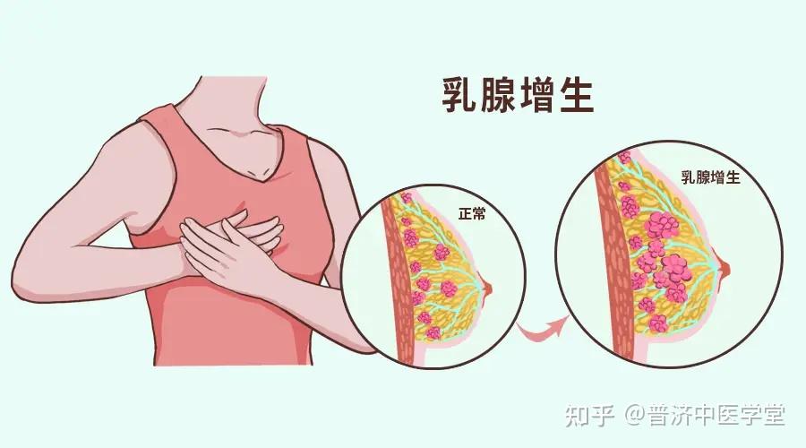 乳腺增生症前期图片