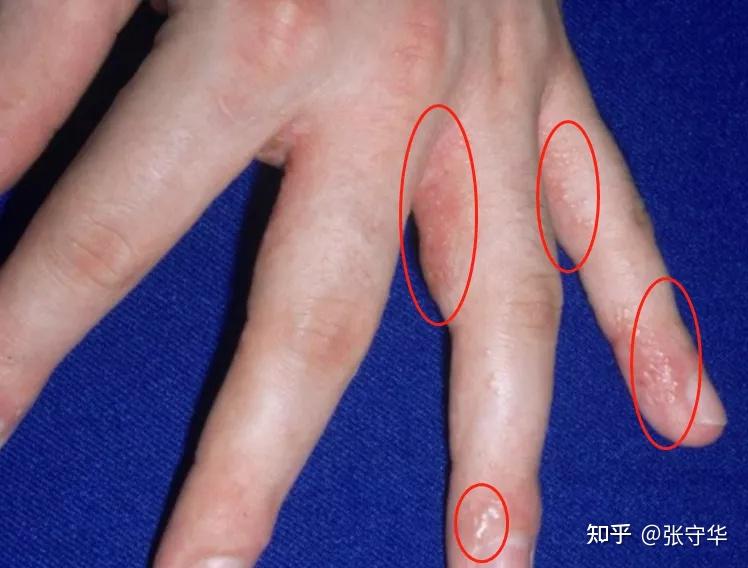 脚气会传染到手上吗?