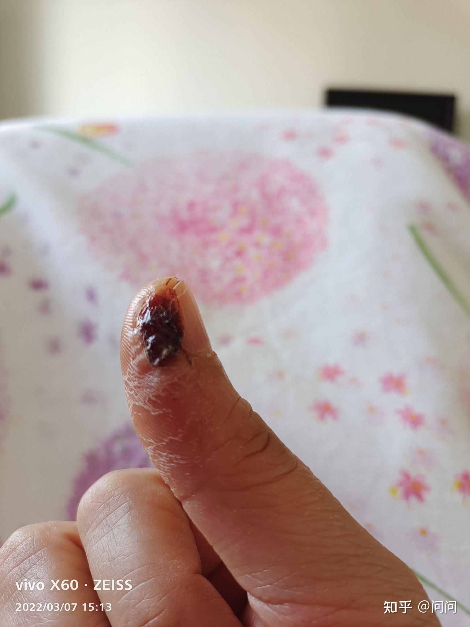 手指切伤后长好以后会变回原来的样子吗. - 知乎