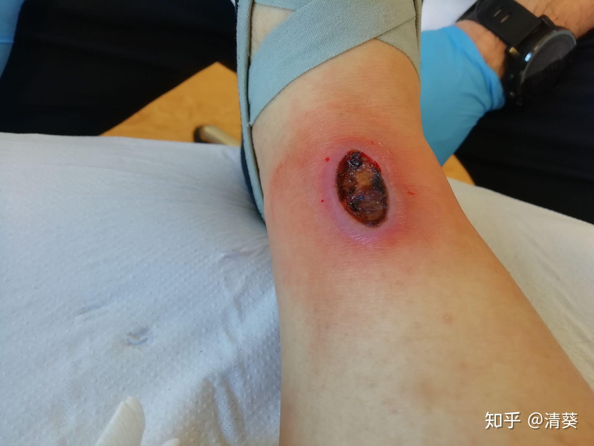 低温烫伤怎么办? - 知乎