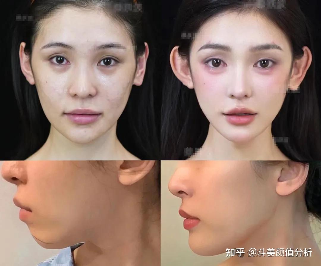 下巴后缩很丑怎么办?下巴后缩做正颌还是垫下巴好？国 …