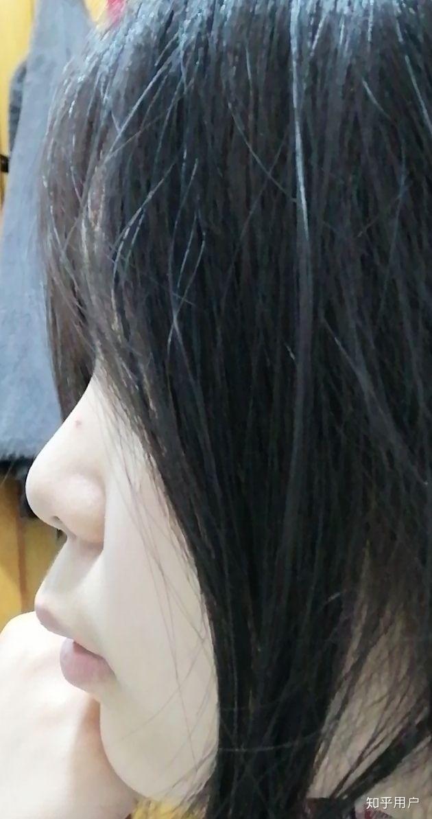 龅牙凸嘴怎么改善侧脸? - 知乎