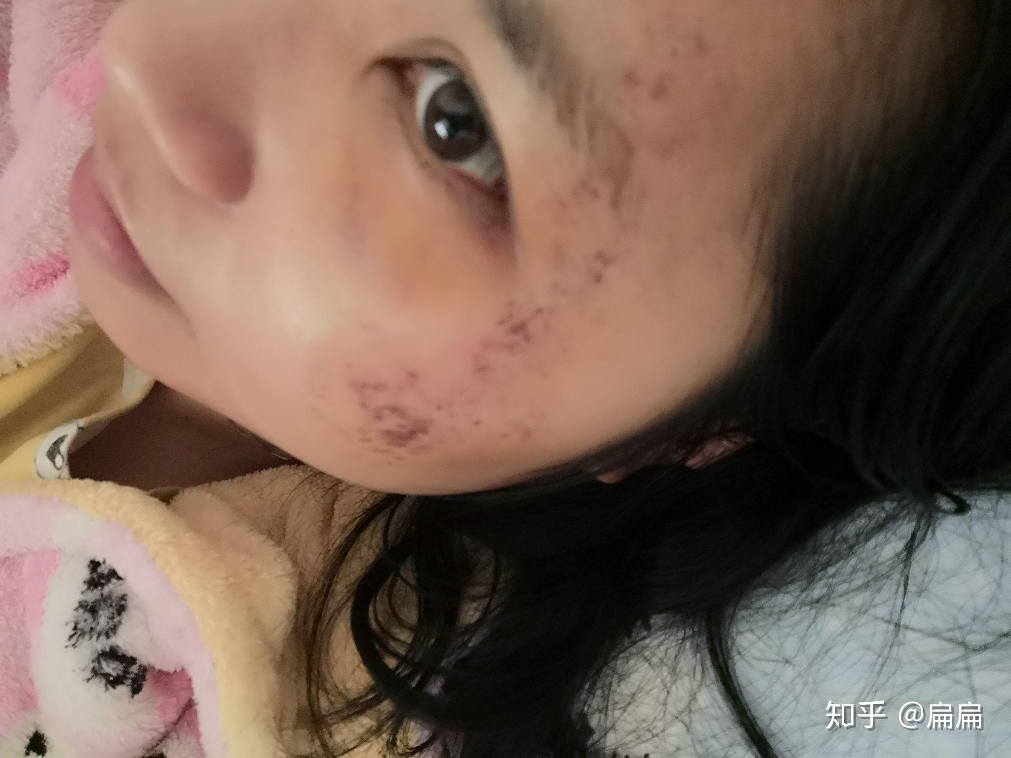 但是红黑的一片,怎样才能避免留疤? - 知乎