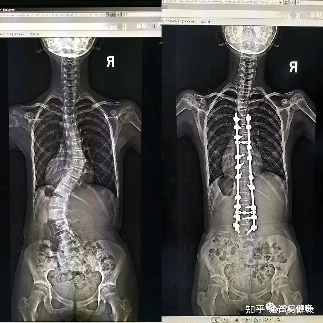 如何保守治疗脊柱侧弯