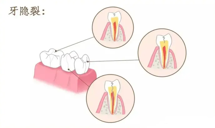 有一种牙痛叫牙隐裂