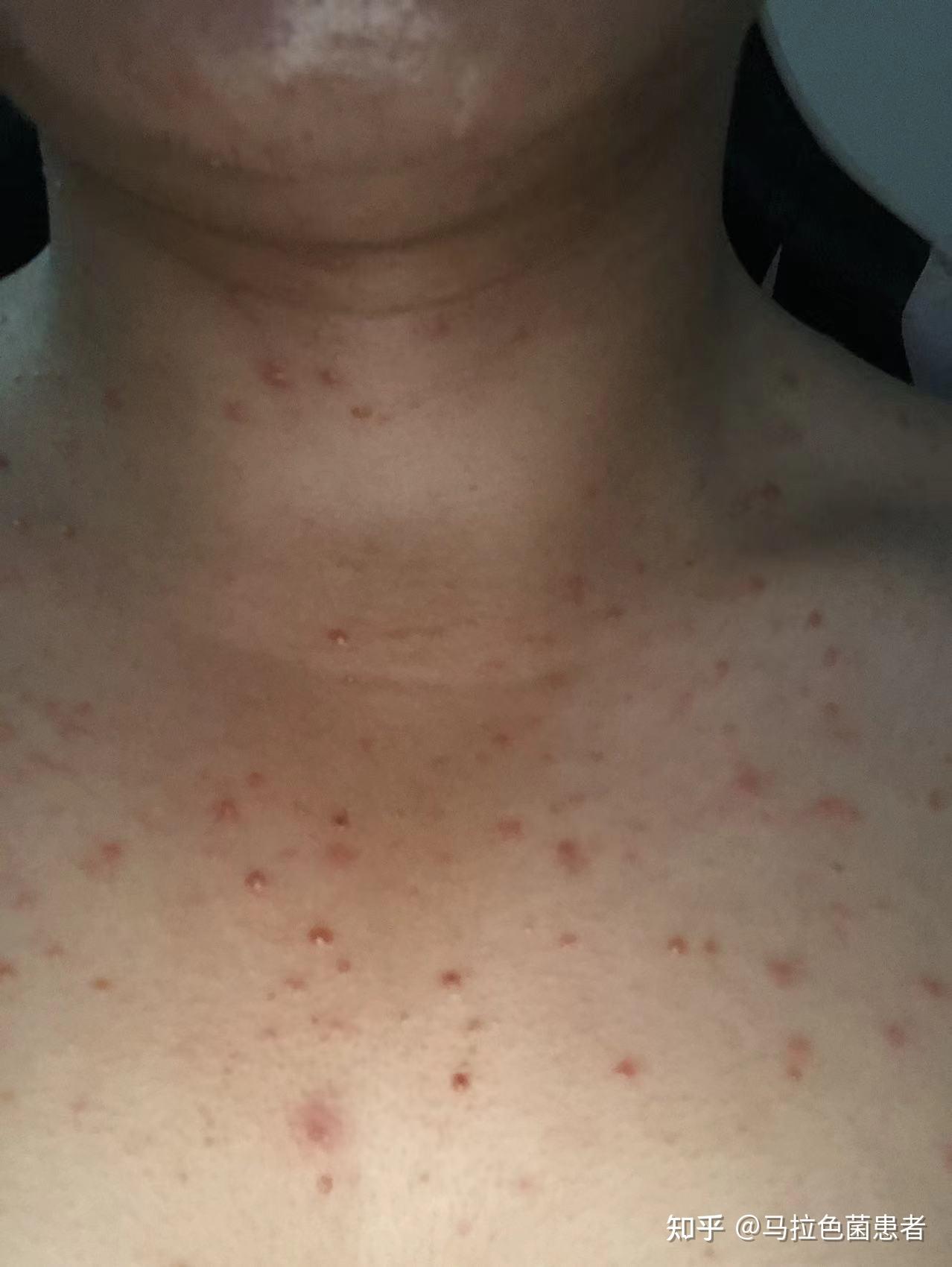 大家帮我看一下我这是毛囊炎吗,胸口反反复复一年了一直这样? - 知乎
