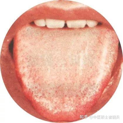史上最全高清舌诊图谱,堪比教科书(收藏篇) - 知乎