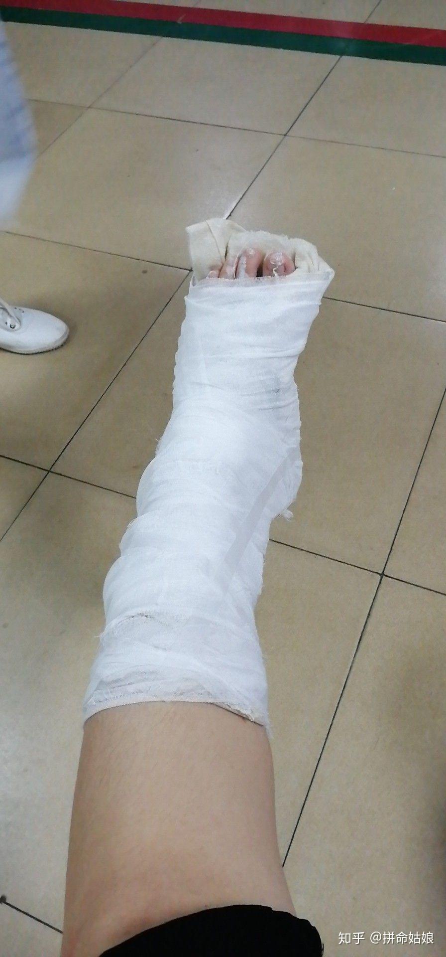 左脚第五跖骨骨折? - 知乎