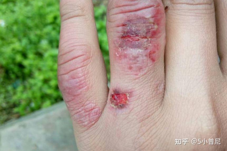冻手怎么预防？并不是穿的越厚越好啊！ - 知乎
