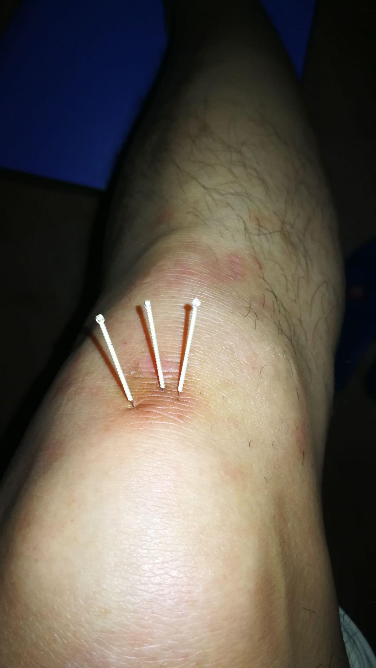 髌下脂肪垫损伤后,如何进行恢复性训练?