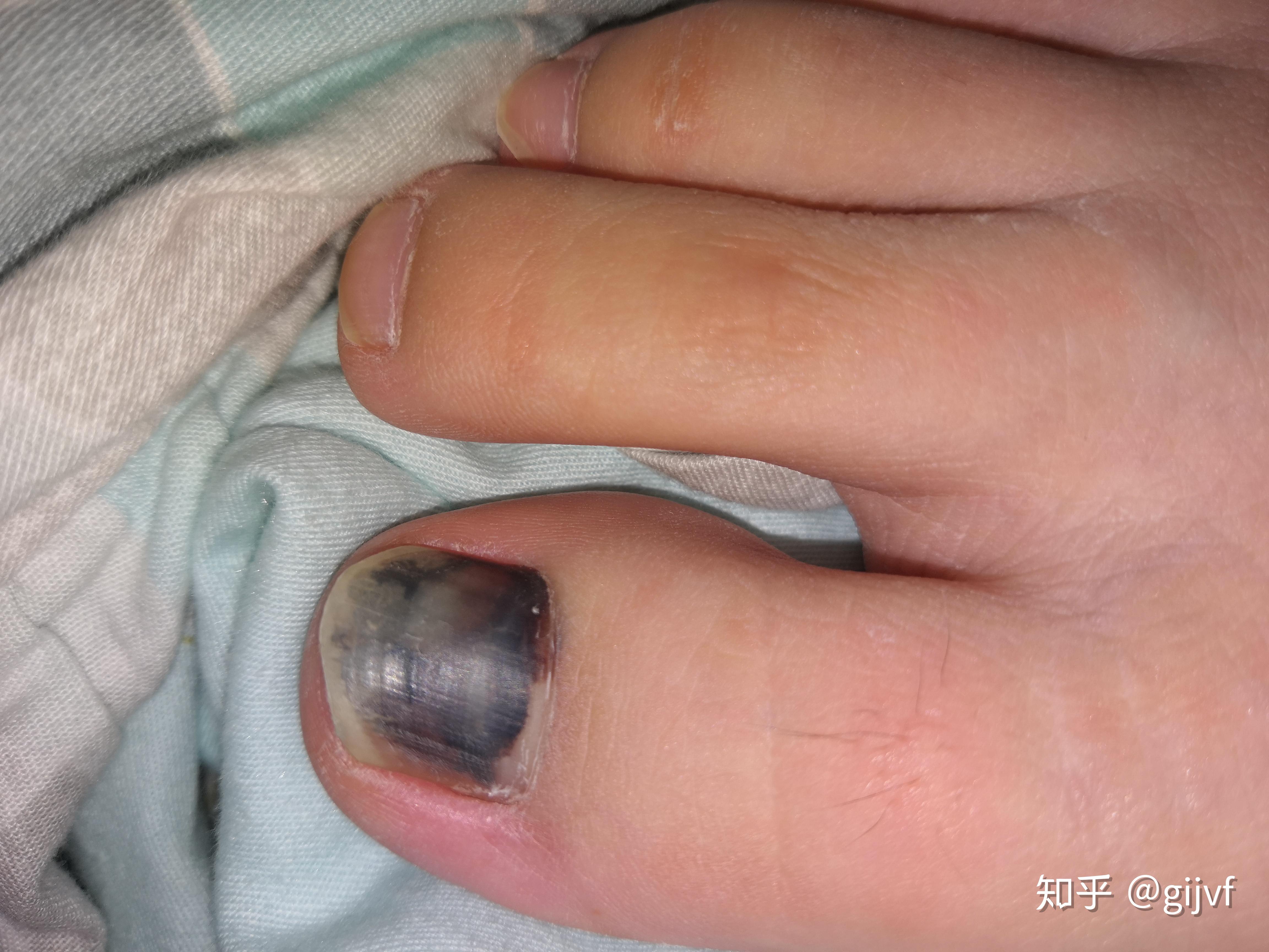 请问这是甲下淤血吗