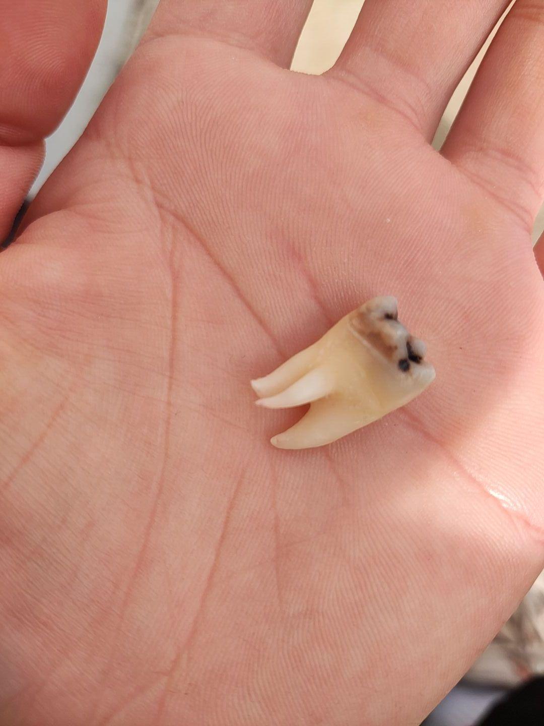 请问智齿牙根是弯的好拔吗? - 知乎
