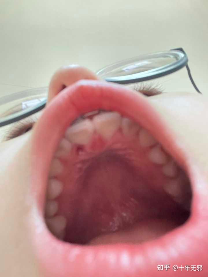 上颚长了一个白色硬的像牙齿一样的东西 是什么啊 ?