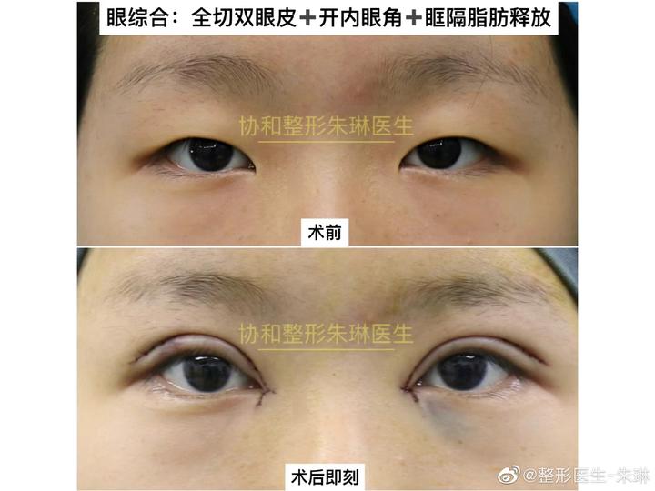 北京眼综合:全切双眼皮 开内眼角 眶隔脂肪释放。 - 知乎