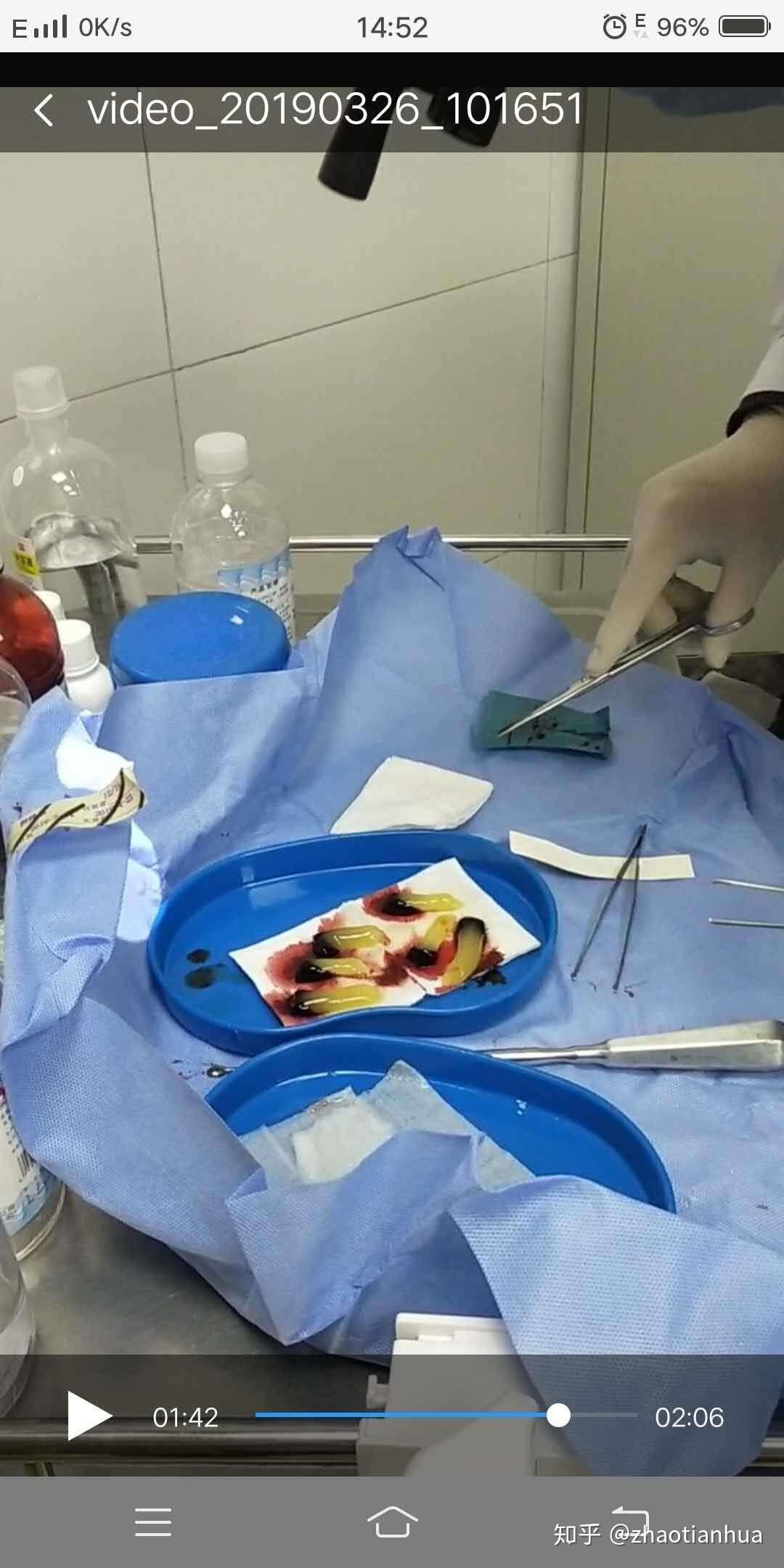 知乎有得过藏毛窦的朋友吗医生说我得了藏毛窦需要做手术大概要十多天