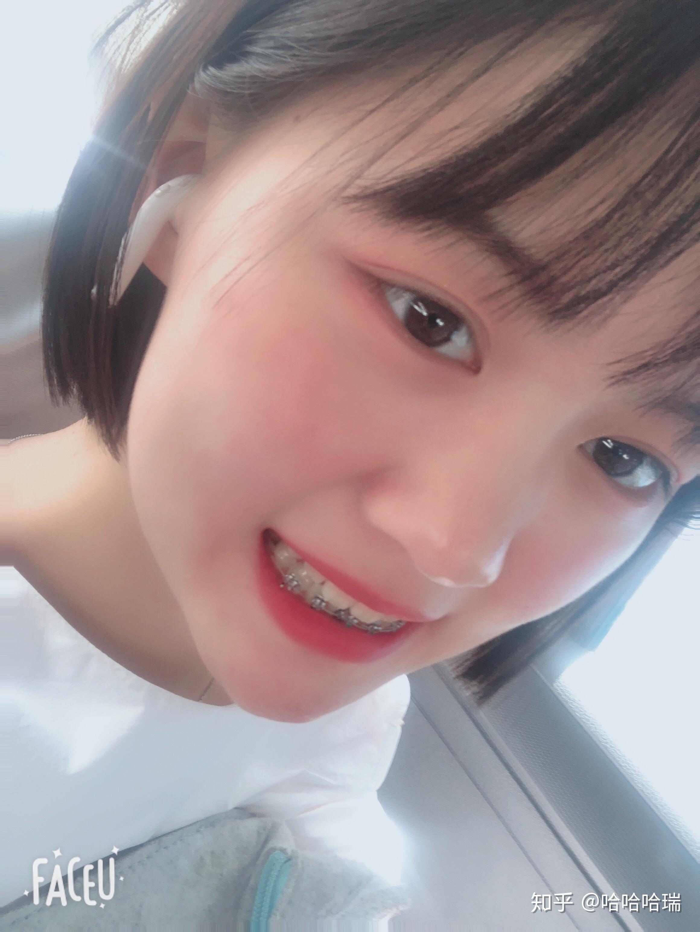 有哪些戴牙套好看的照片吗