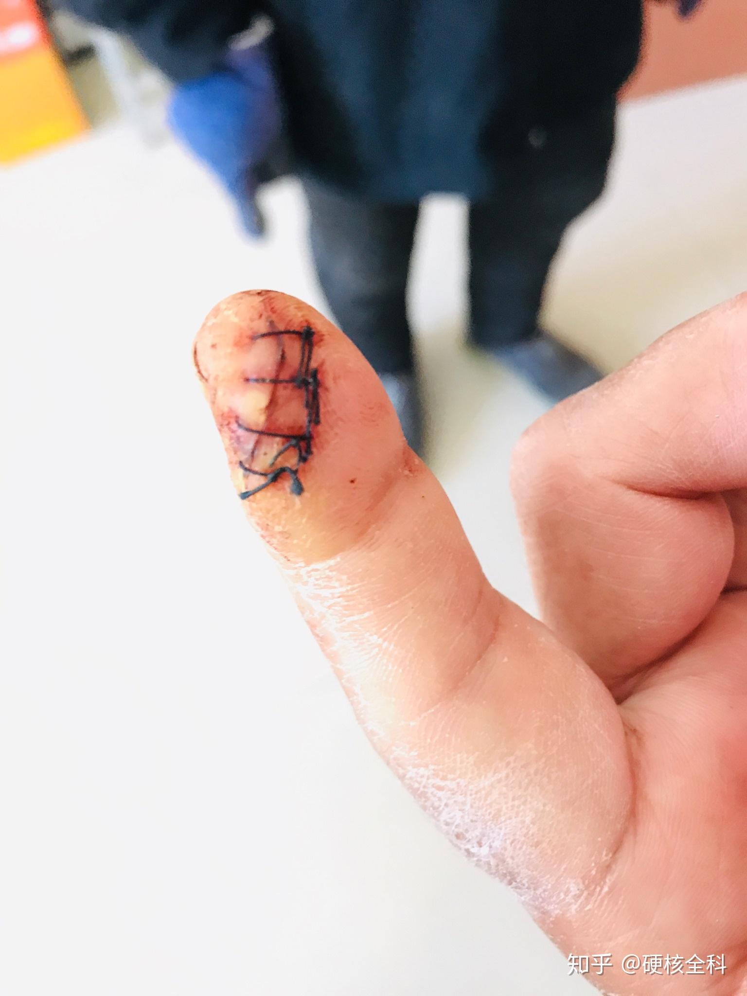 你有什么在手术过程中的切开组织图?