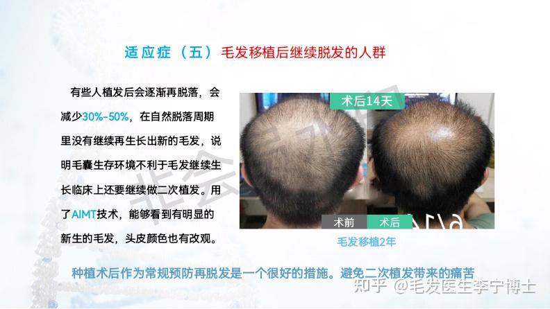 现在有比植发更先进的毛囊克隆技术吗?