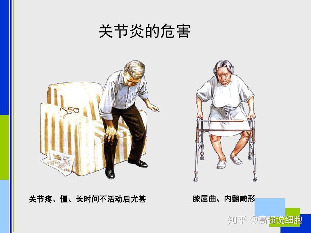 干细胞治疗膝关节炎效果怎么样