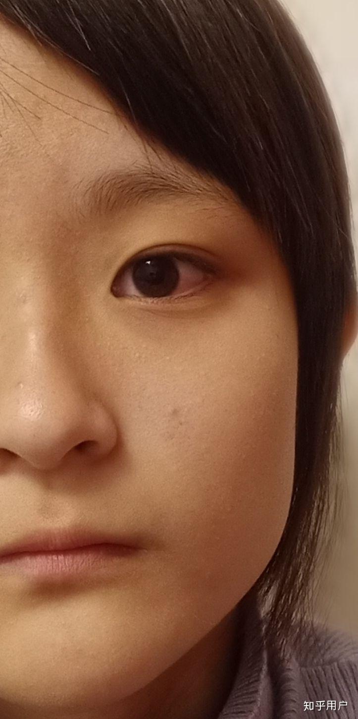 眼睛一单一双是什么体验? - 知乎