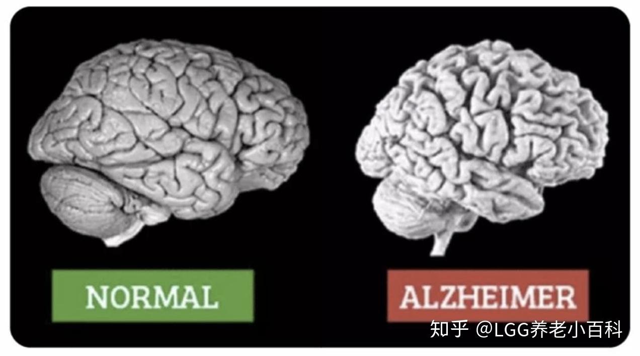 阿爾茨海默症是一種什麼樣的病症有哪些病因與症狀該如何預防與治療呢