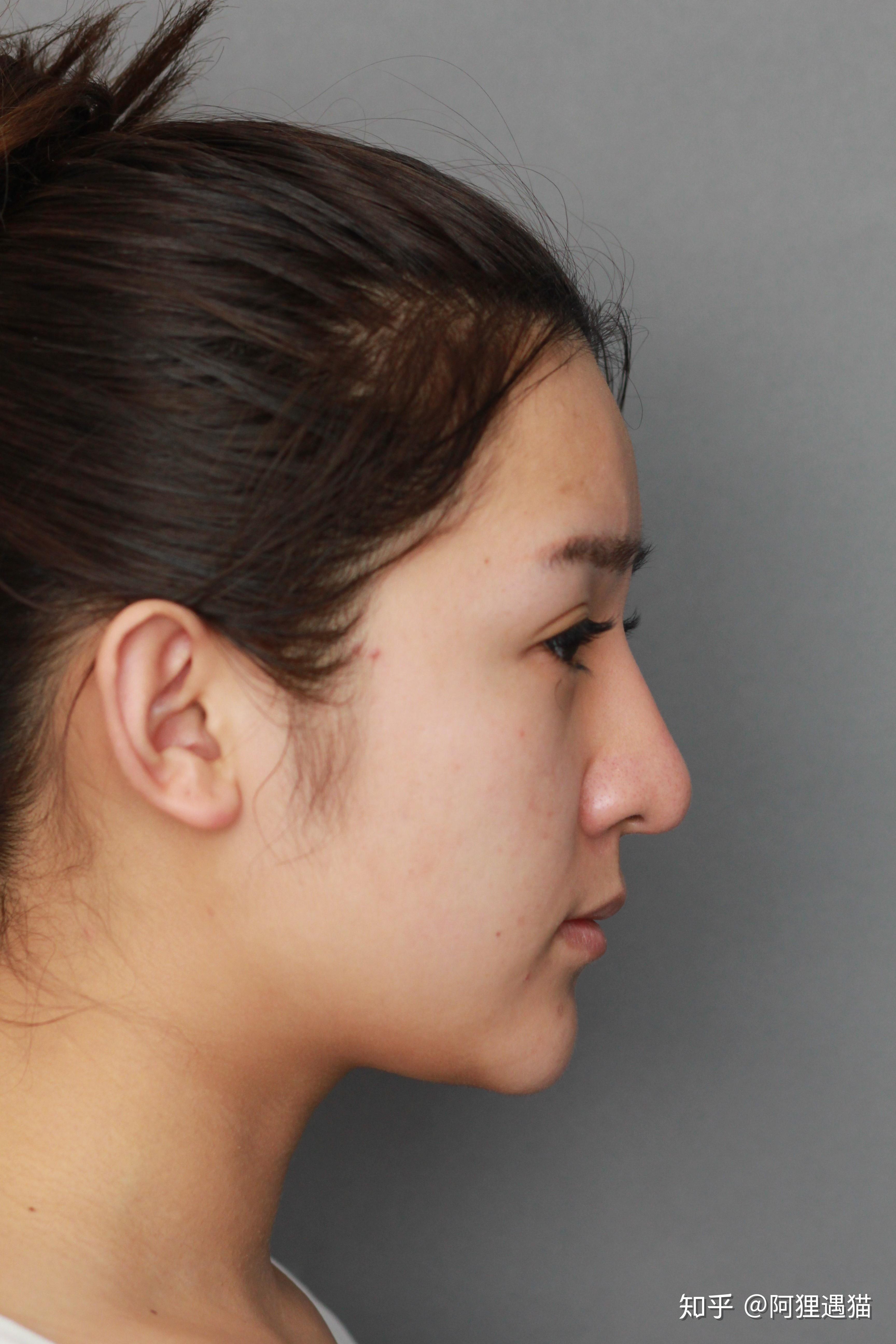 鼻子两侧的肉多怎么办