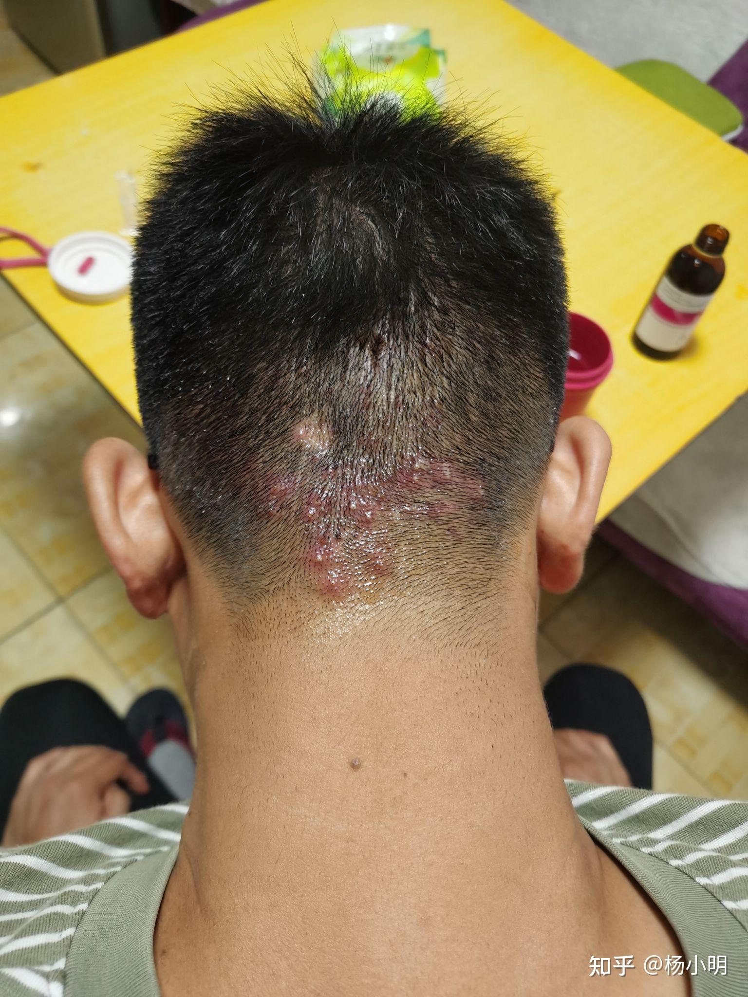 脑袋后面长了好多小疙瘩? - 知乎