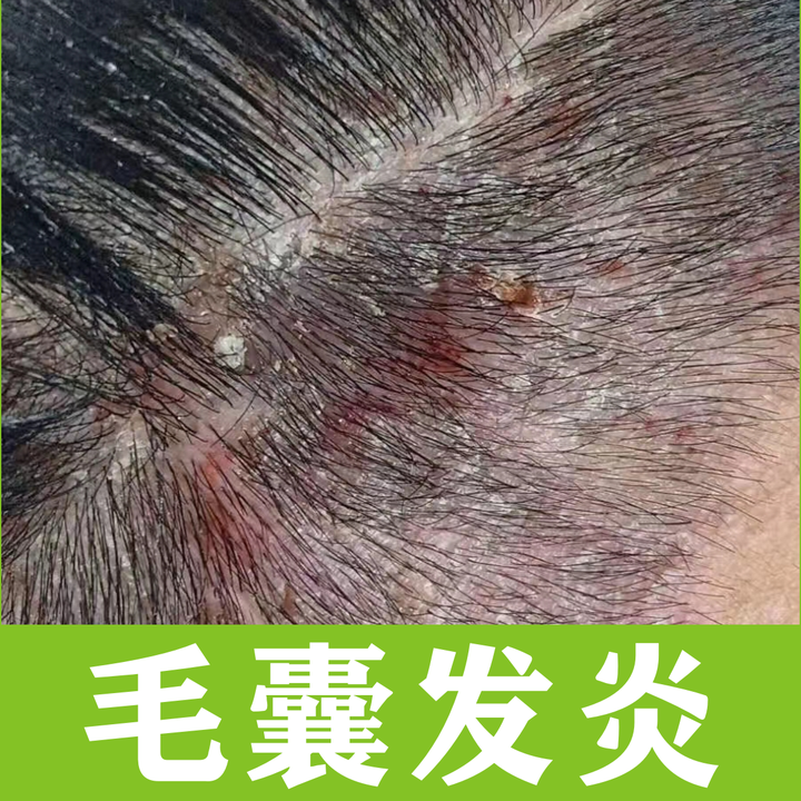 毛囊炎总是反反复复?3招教你对付它 - 知乎