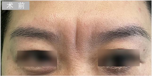 立于双眉间,竖穿印堂,人称"斩子纹",医生:有川字纹只是皱眉肌发达