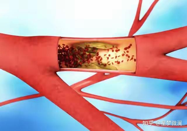 血栓是如何形成的,有哪些方式能够降低血栓出现的概率? - 知乎