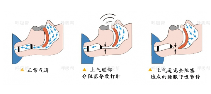普通打呼噜和阻塞睡眠呼吸暂停有啥区别?一文为您揭晓! - 知乎