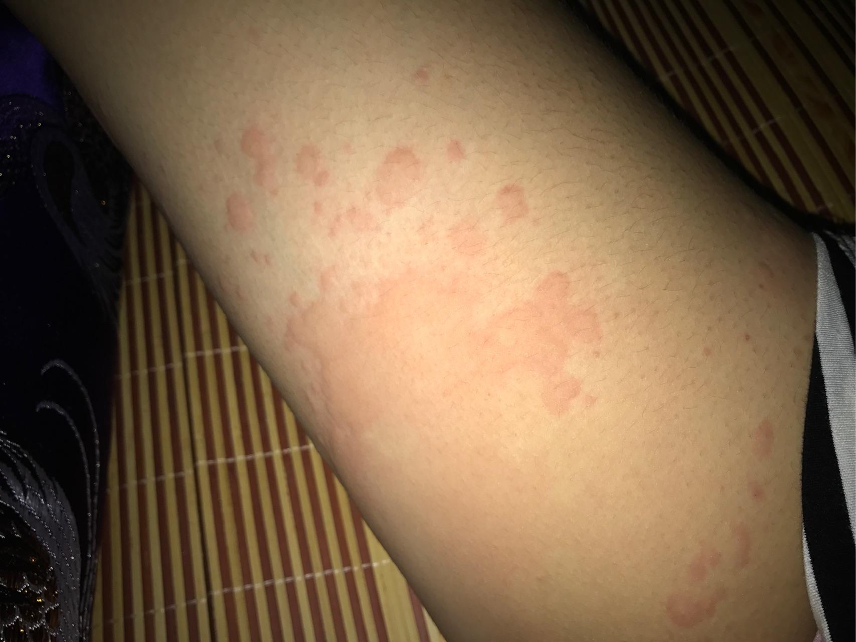 有没有小伙伴和我一样的荨麻疹症状上图