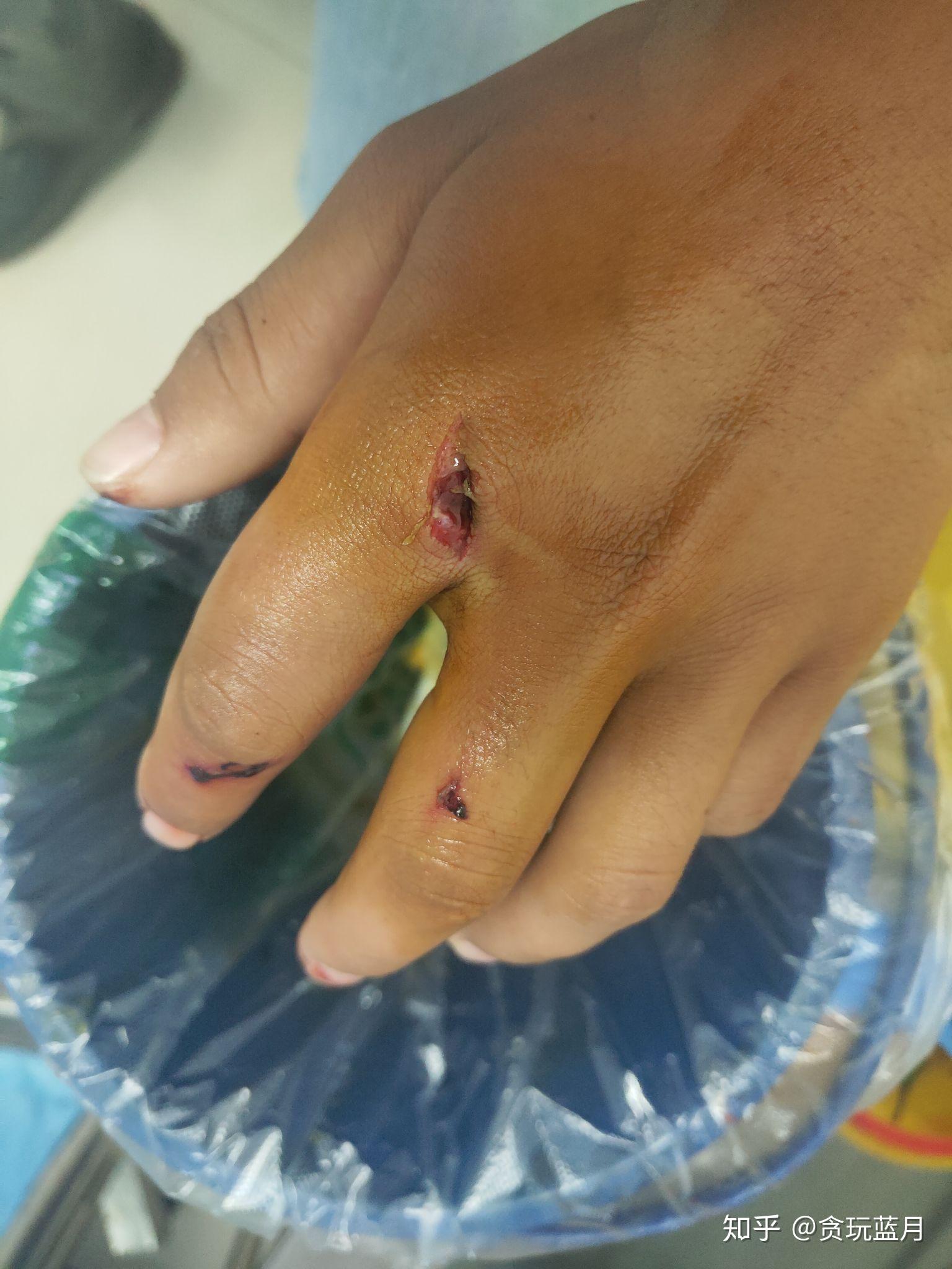 工地受伤骨折怎么赔偿