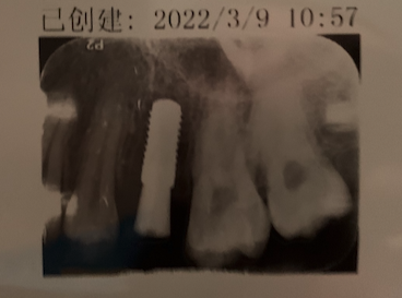 记北京口腔医院种植牙的过程及费用 - 知乎