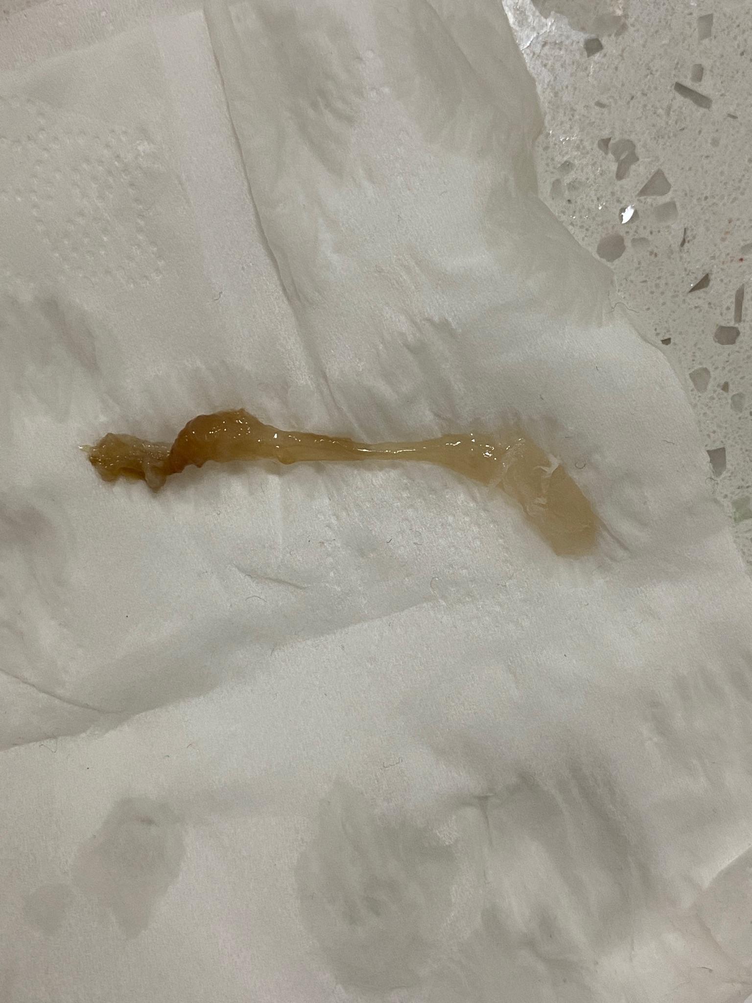 请问大家药流有残留排出后是什么样子的? - 知乎