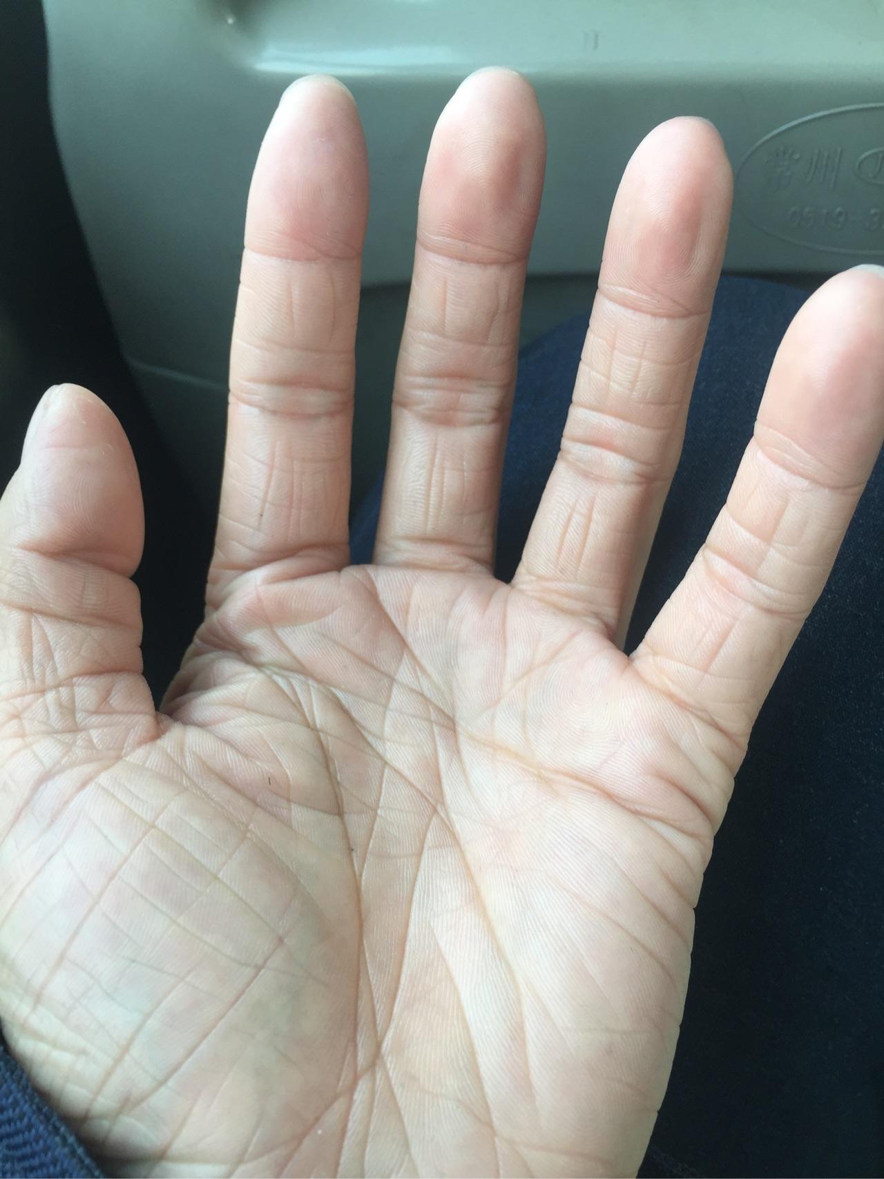 年纪轻轻23岁手上皮肤就很干有很多皱纹,像老年人干瘪的手,怎么办呀?