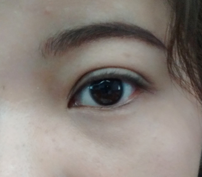 眼皮厚有可能减眼皮的脂肪吗如何消除眼皮脂肪