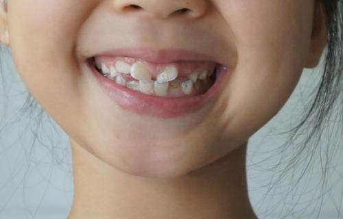 牙齿反合治疗注意事项