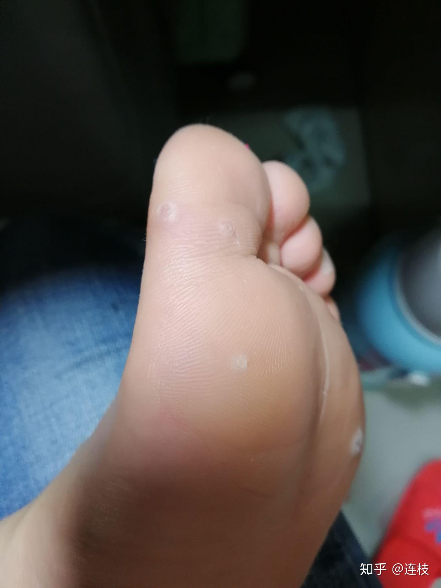 脚上感染长了疣怎么弄