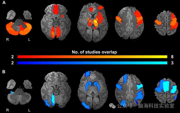 Brain Stimul:利用功能磁共振成像探究脑深部刺激的反应 - 知乎