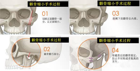 千万不要做颧骨内推,会松弛下垂!做颧骨颧弓内推手术要注意什么?如何选择靠谱的医生降低手术风险、减少后遗症发生概率? - 知乎
