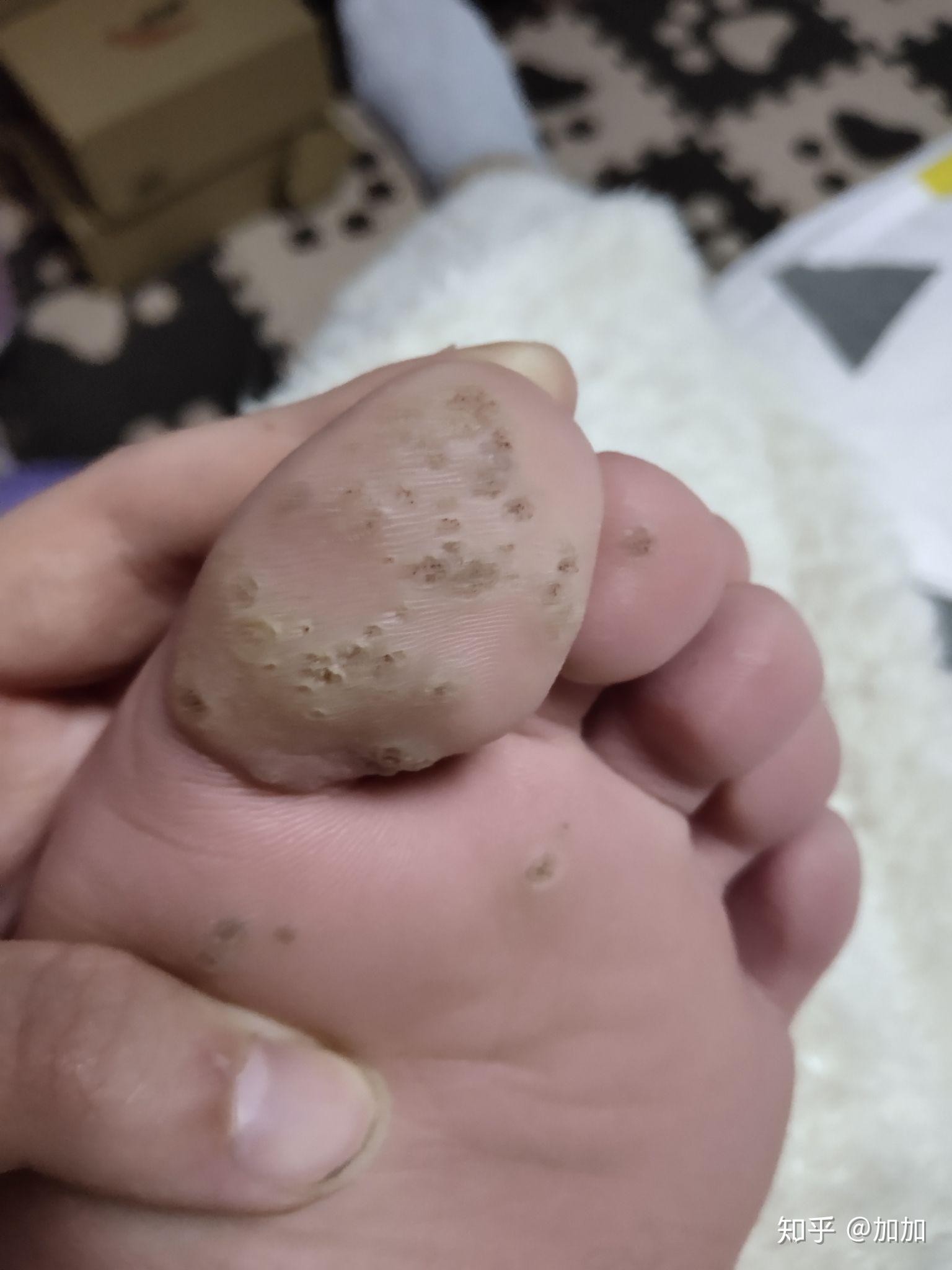 如何去除脚底上的疣
