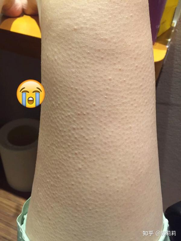 怎样改善鸡皮肤?